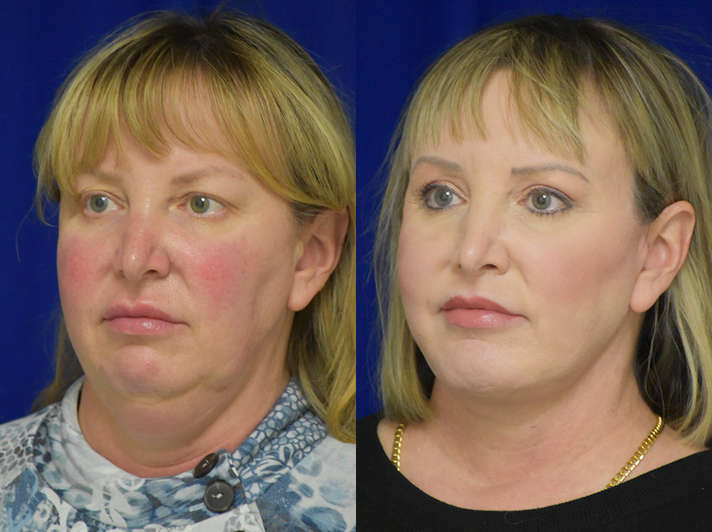 Blepharoplasty before and after photo by Dr. Sean Weiss in Metairie LA