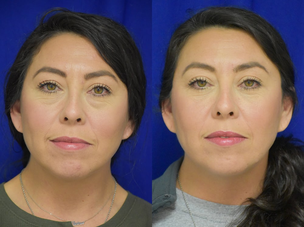 Blepharoplasty before and after photo by Dr. Sean Weiss in Metairie LA
