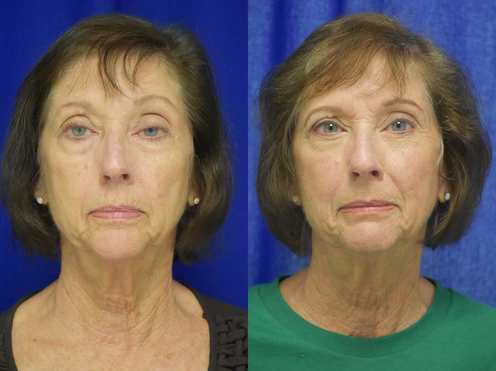 Blepharoplasty before and after photo by Dr. Sean Weiss in Metairie LA