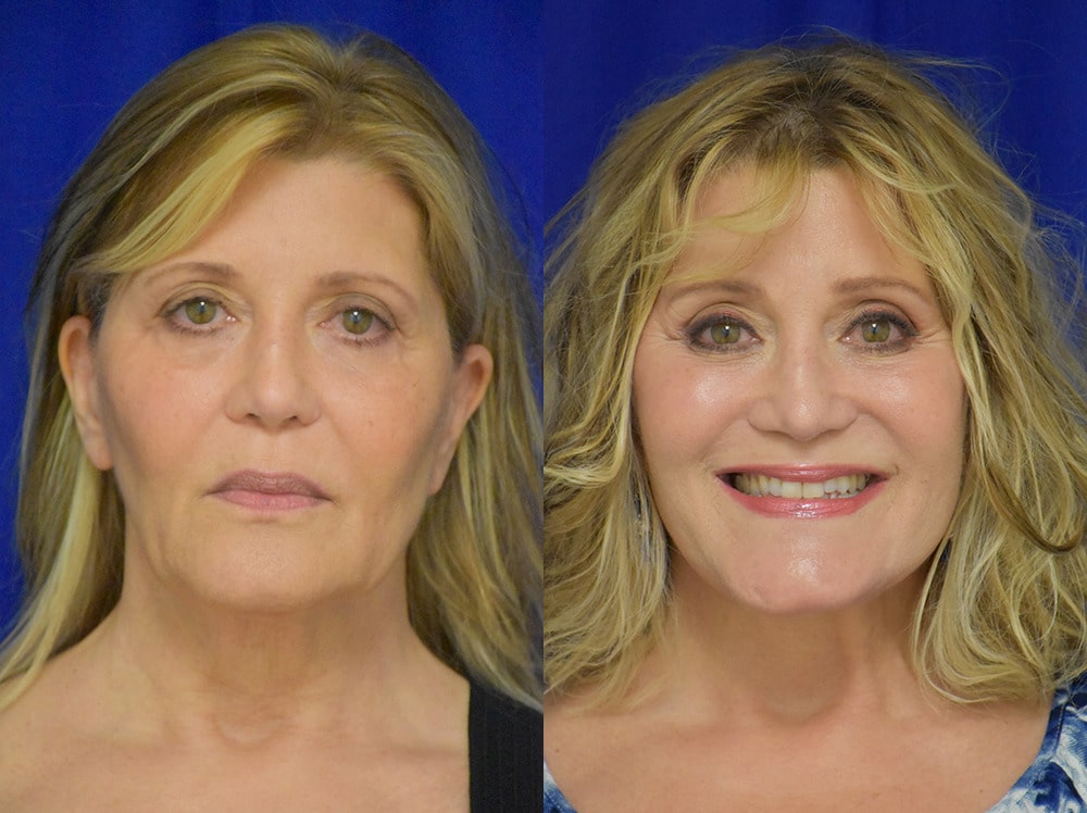 Blepharoplasty before and after photo by Dr. Sean Weiss in Metairie LA