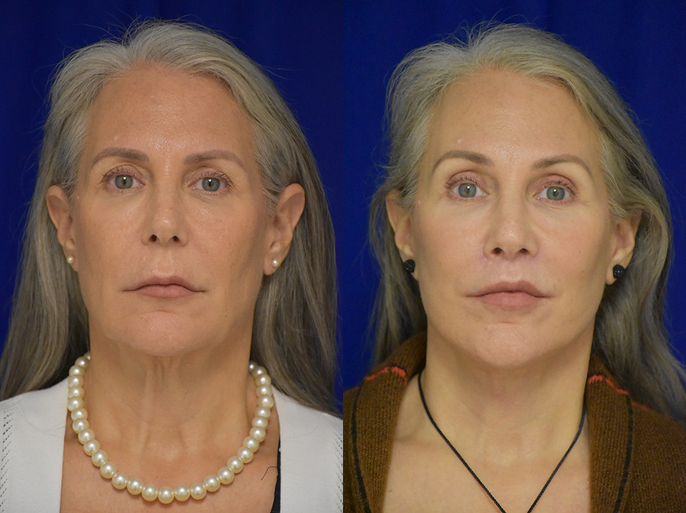 Brow lift before and after photo by Dr. Sean Weiss in Metairie LA