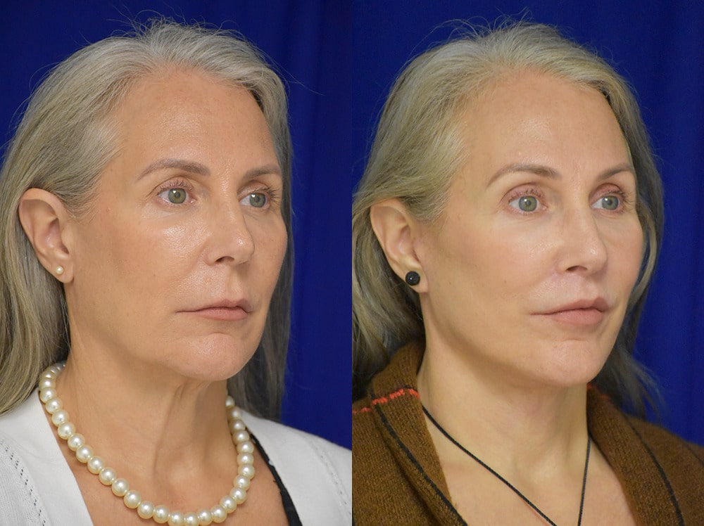 Brow lift before and after photo by Dr. Sean Weiss in Metairie LA