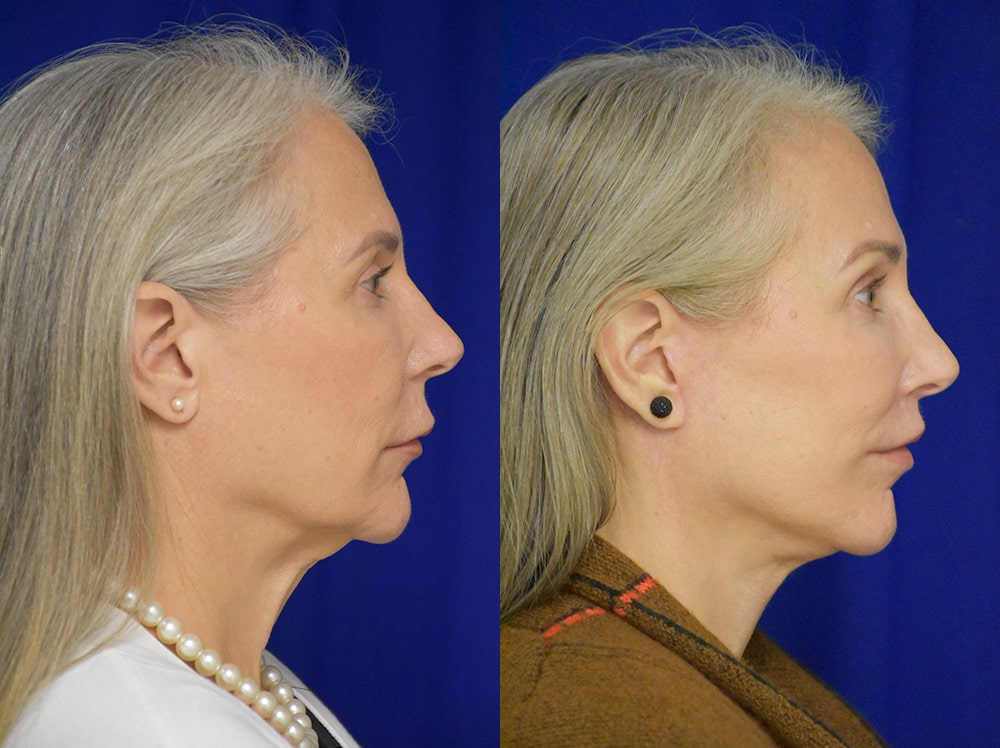 Brow lift before and after photo by Dr. Sean Weiss in Metairie LA