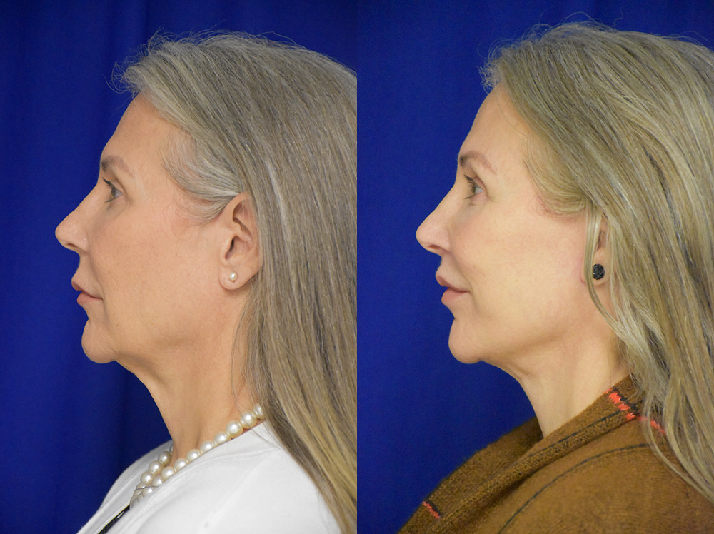 Brow lift before and after photo by Dr. Sean Weiss in Metairie LA