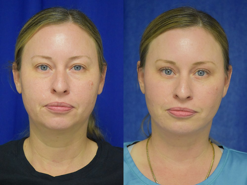 Blepharoplasty before and after photo by Dr. Sean Weiss in Metairie LA