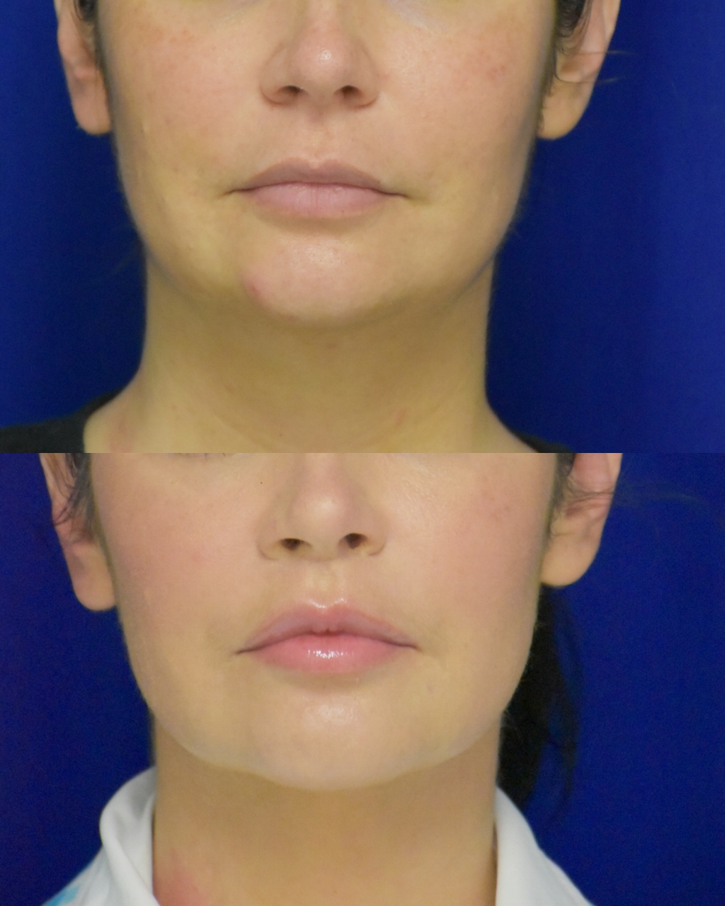 Lip Lift before and after photo by Dr. Sean Weiss in Metairie LA