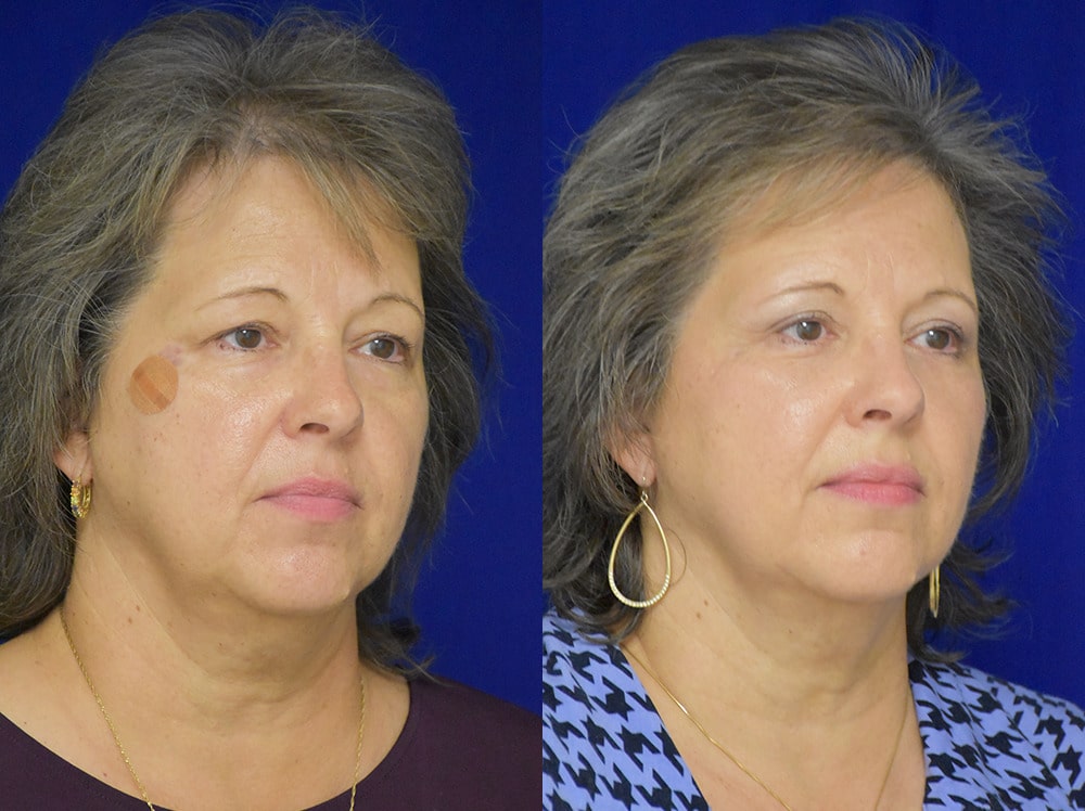 Blepharoplasty before and after photo by Dr. Sean Weiss in Metairie LA