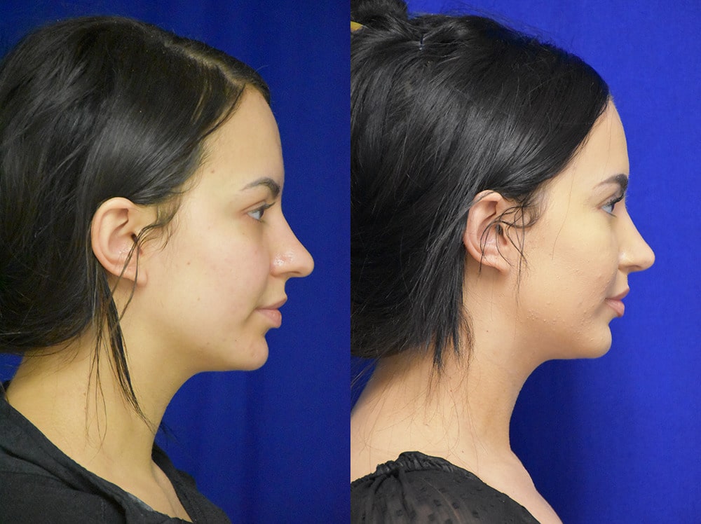 Rhinoplasty before and after photo by Dr. Sean Weiss in Metairie LA