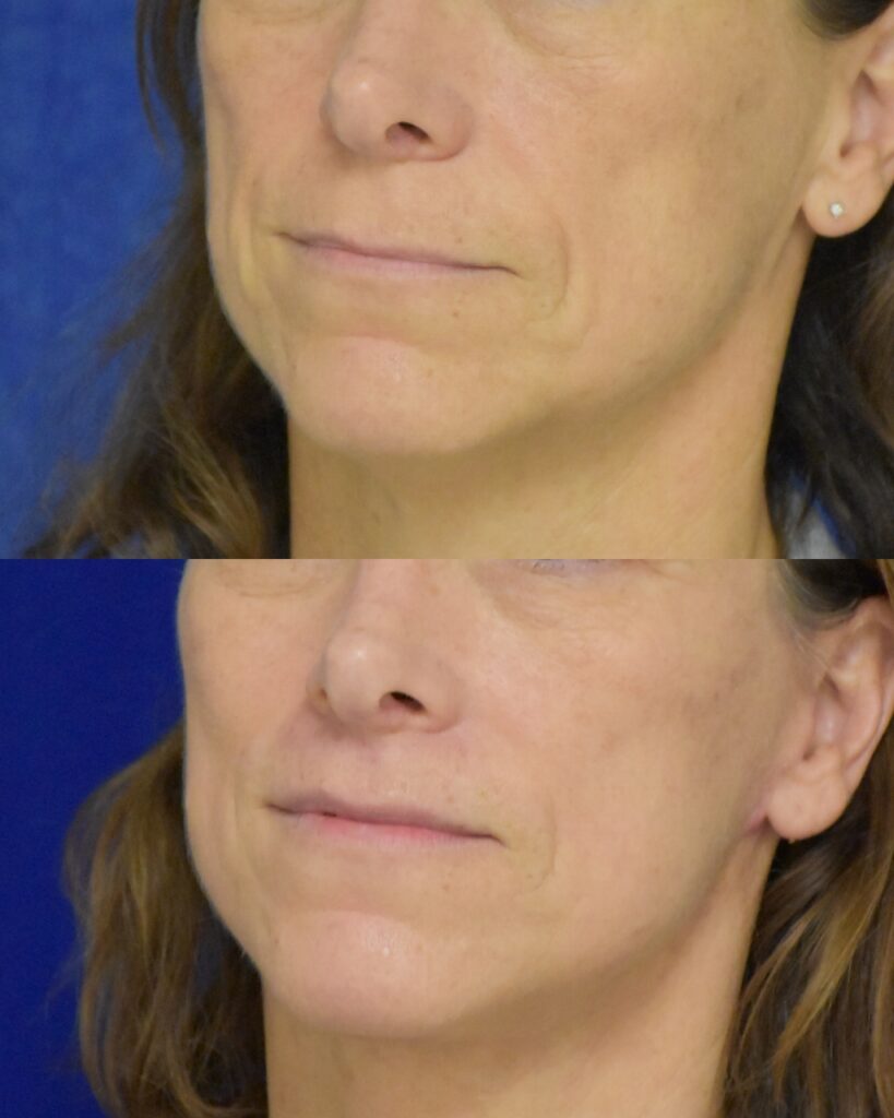 Lip Lift before and after photo by Dr. Sean Weiss in Metairie LA
