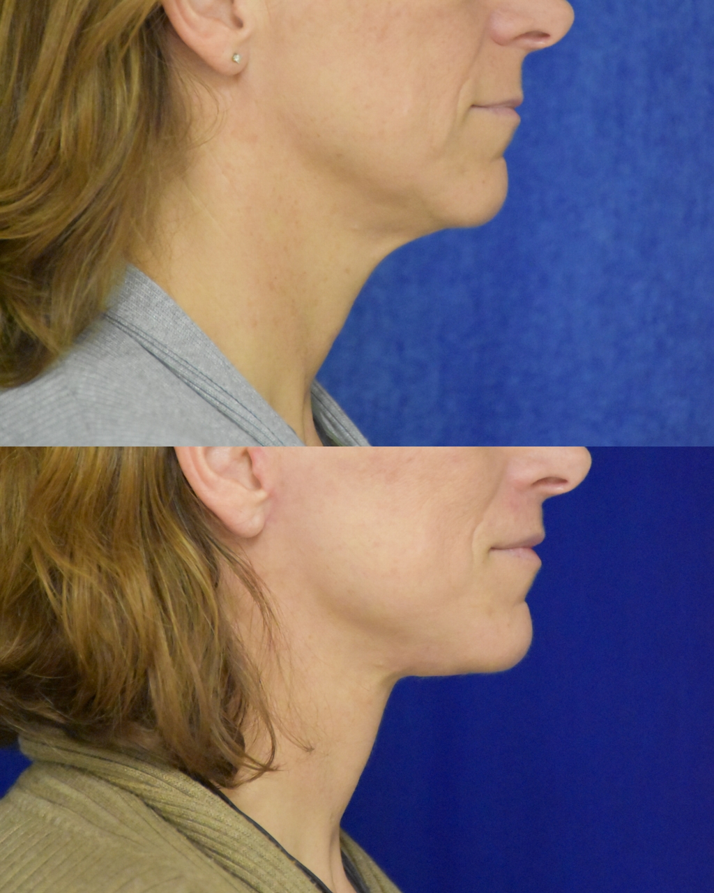 Lip Lift before and after photo by Dr. Sean Weiss in Metairie LA