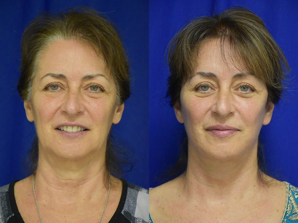 Blepharoplasty before and after photo by Dr. Sean Weiss in Metairie LA