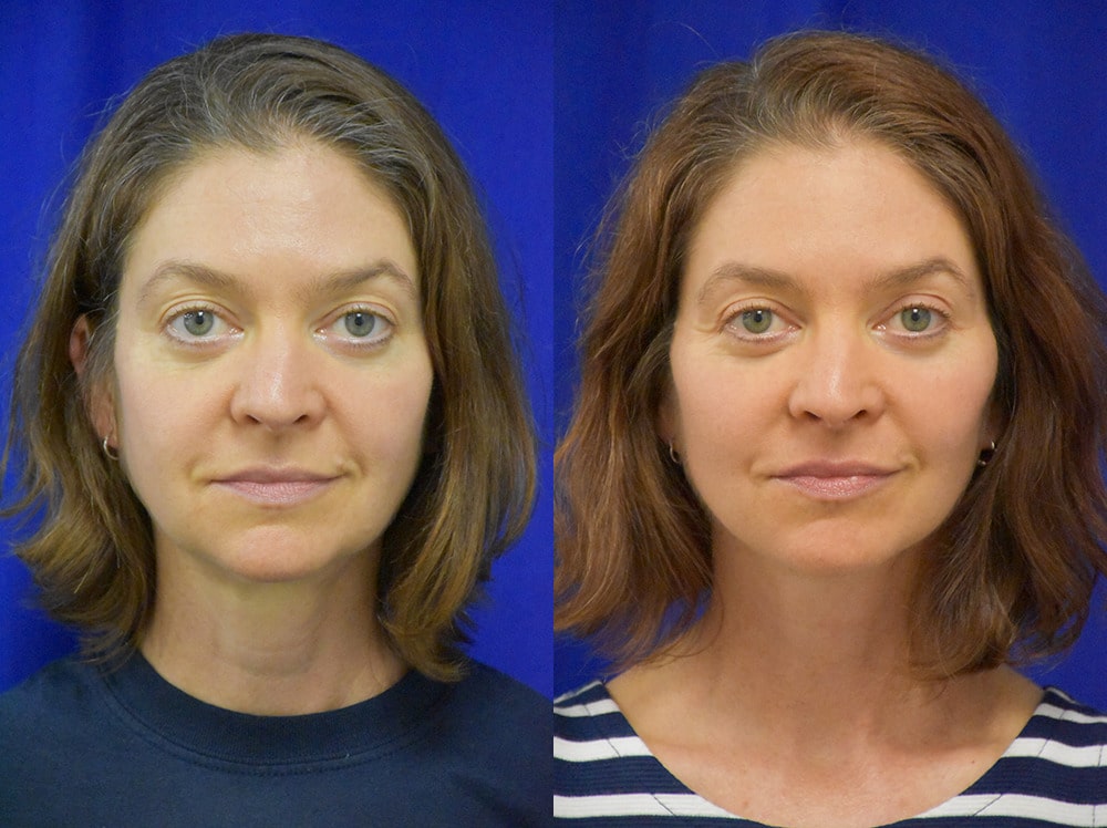 Blepharoplasty before and after photo by Dr. Sean Weiss in Metairie LA