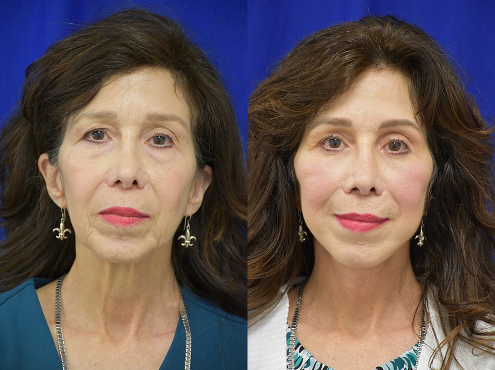 Blepharoplasty before and after photo by Dr. Sean Weiss in Metairie LA