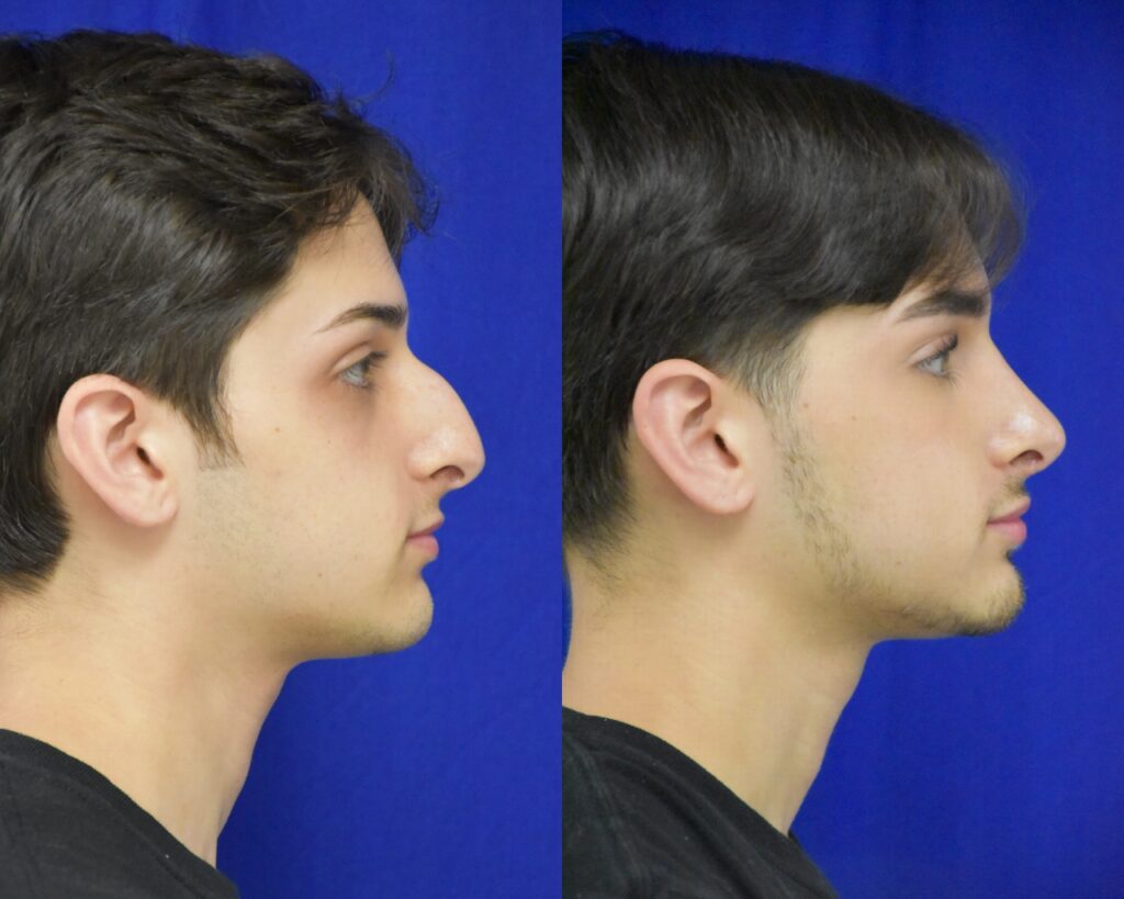 Rhinoplasty before and after photo by Dr. Sean Weiss in Metairie, LA