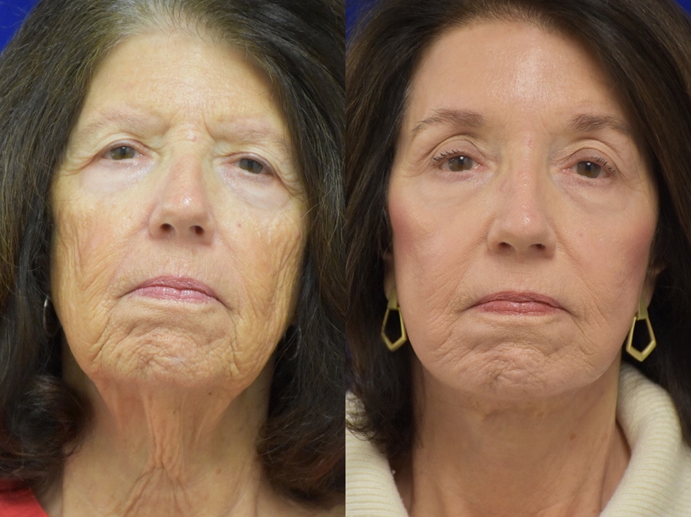 Deep Plane Facelift, Endoscopic Brow Lift, 20% TCA Peel before and after photo by Dr. Sean Weiss in Metairie LA