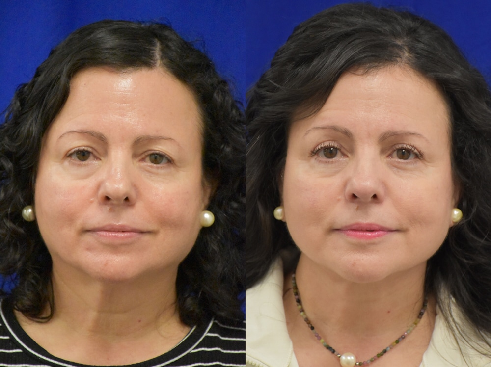 Facelift, Fat Transfer, Lateral Browlift, Upper Blepharoplasty before and after photo by Dr. Sean Weiss in Metairie LA