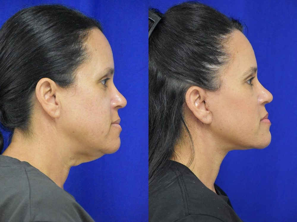 Facelift before and after photo by Dr. Sean Weiss in Metairie LA