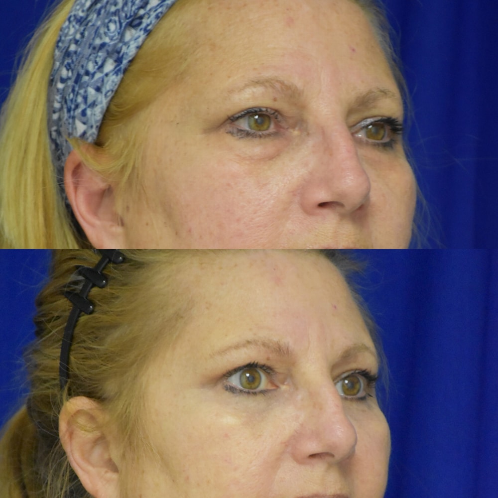 Lower Blepharoplasty before and after photo by Dr. Sean Weiss in Metairie LA