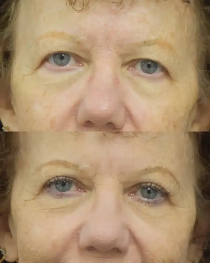 Brow Lift and Blepharoplasty before and after photo by Dr. Sean Weiss in Metairie LA