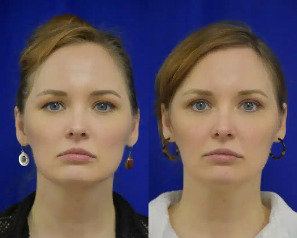 Brow Lift before and after photo by Dr. Sean Weiss in Metairie LA