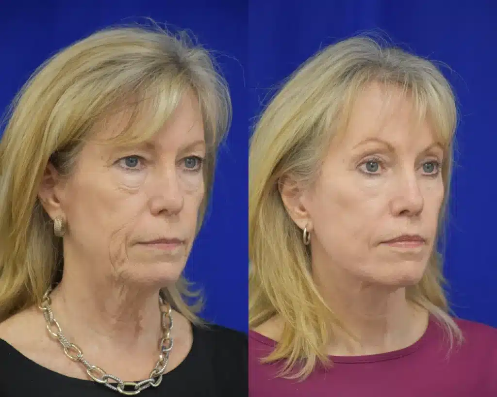 Facelift Blepharoplasty before and after photo by Dr. Sean Weiss in Metairie LA