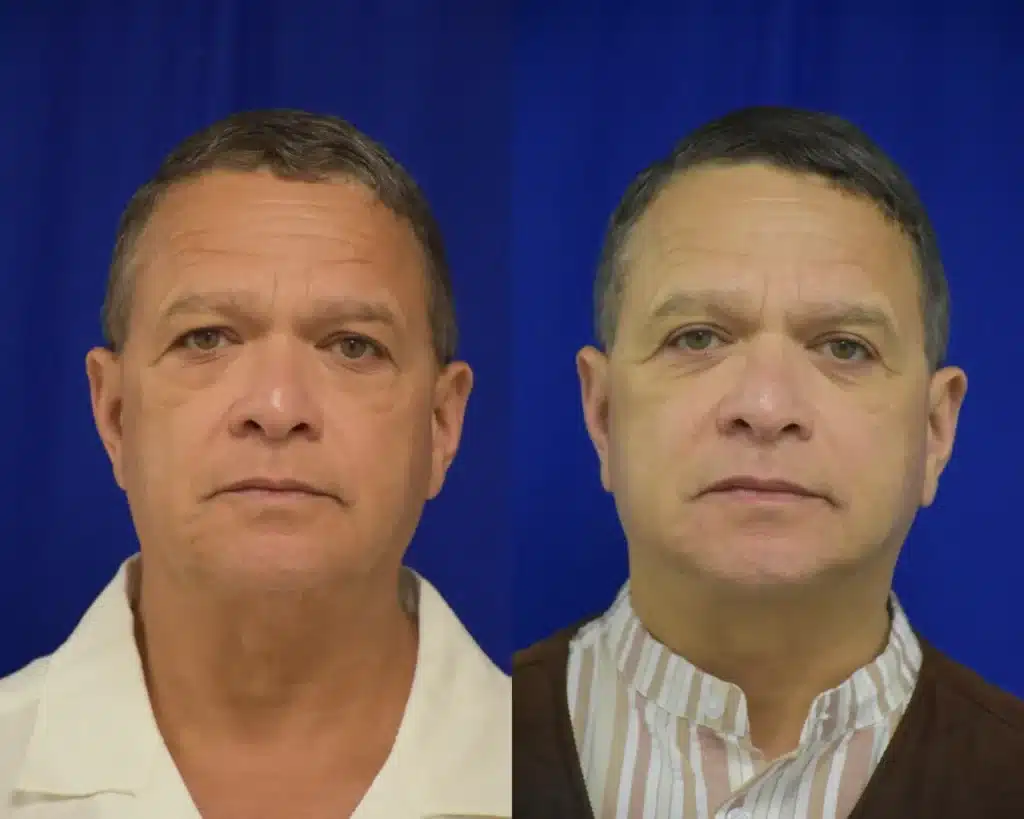 Facelift and Blepharoplasty before and after photo by Dr. Sean Weiss in Metairie LA