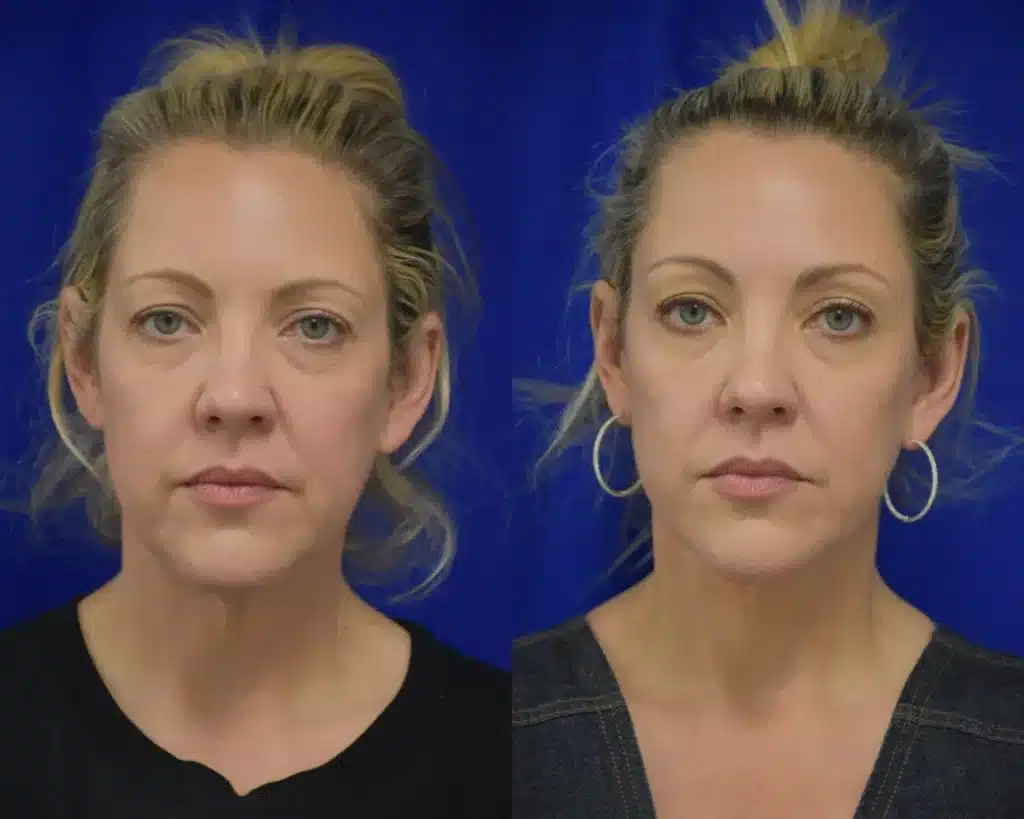 Facelift before and after photo by Dr. Sean Weiss in Metairie LA