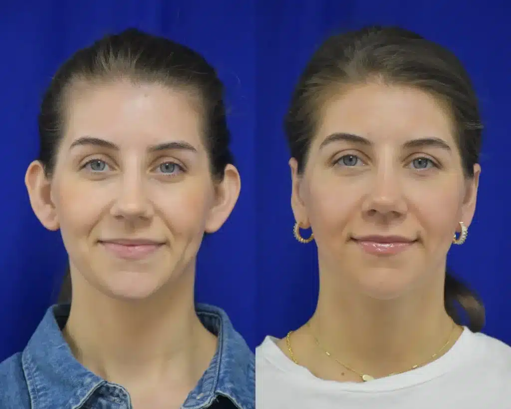 Rhinoplasty Otoplasty before and after photo by Dr. Sean Weiss in Metairie LA