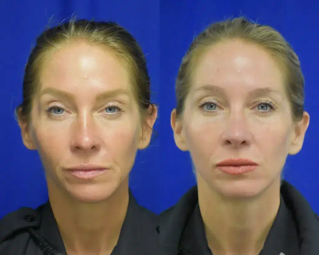 Rhinoplasty before and after photo by Dr. Sean Weiss in Metairie LA
