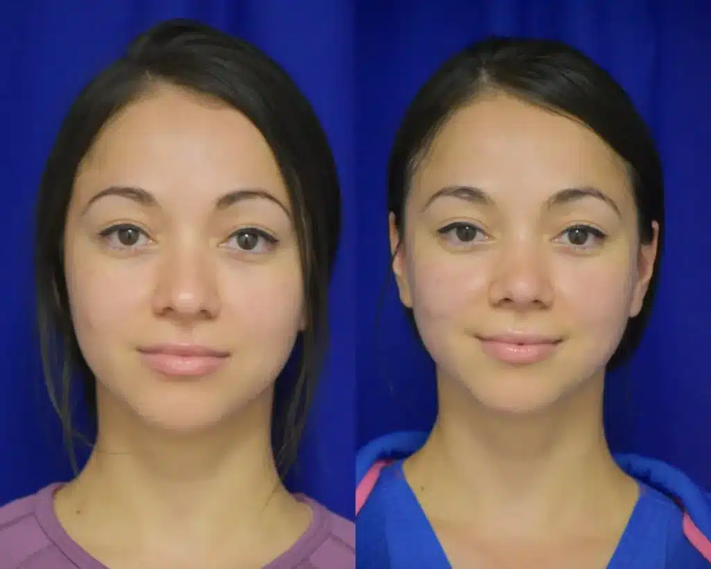 Rhinoplasty before and after photo by Dr. Sean Weiss in Metairie LA