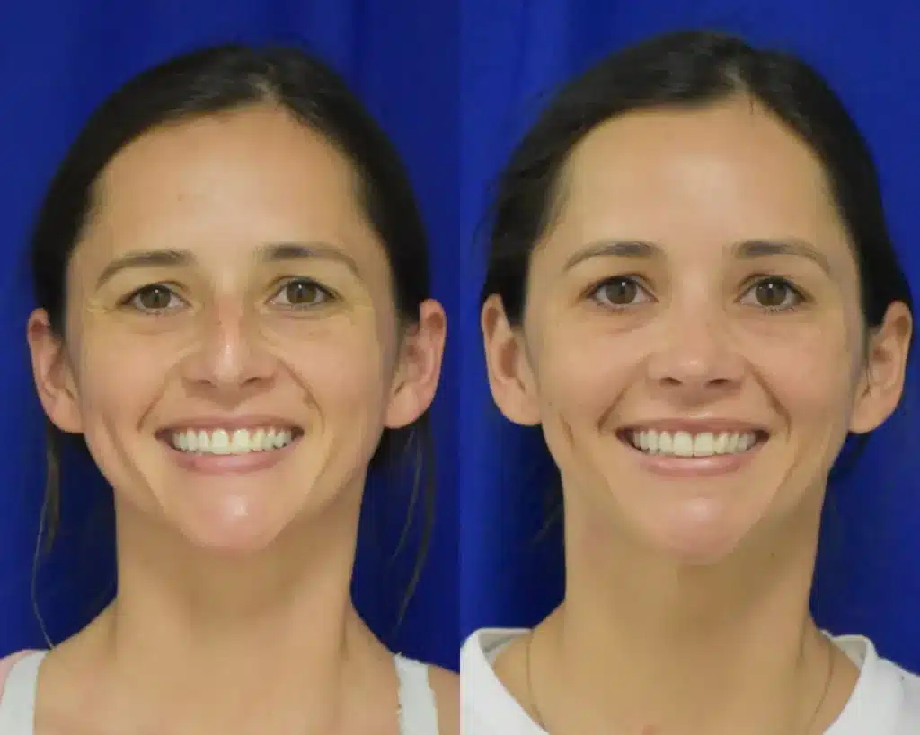 Rhinoplasty before and after photo by Dr. Sean Weiss in Metairie LA