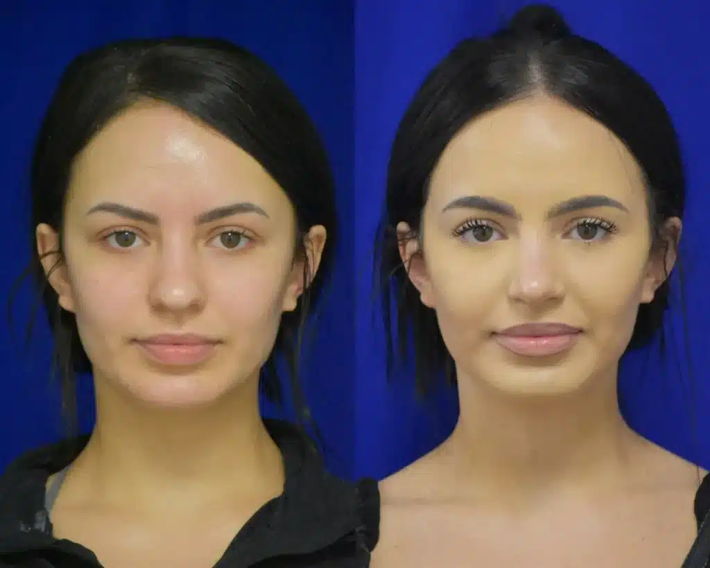 Rhinoplasty before and after photo by Dr. Sean Weiss in Metairie LA