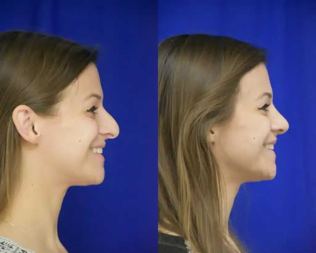 Rhinoplasty before and after photo by Dr. Sean Weiss in Metairie LA
