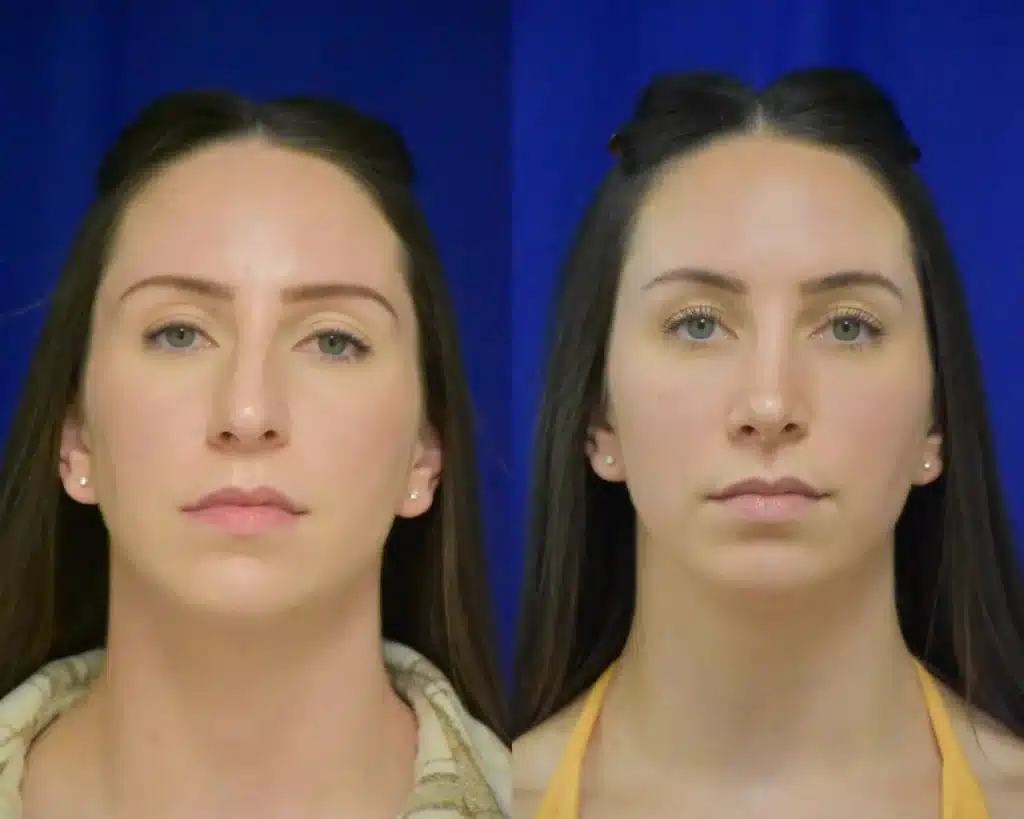 Rhinoplasty before and after photo by Dr. Sean Weiss in Metairie LA