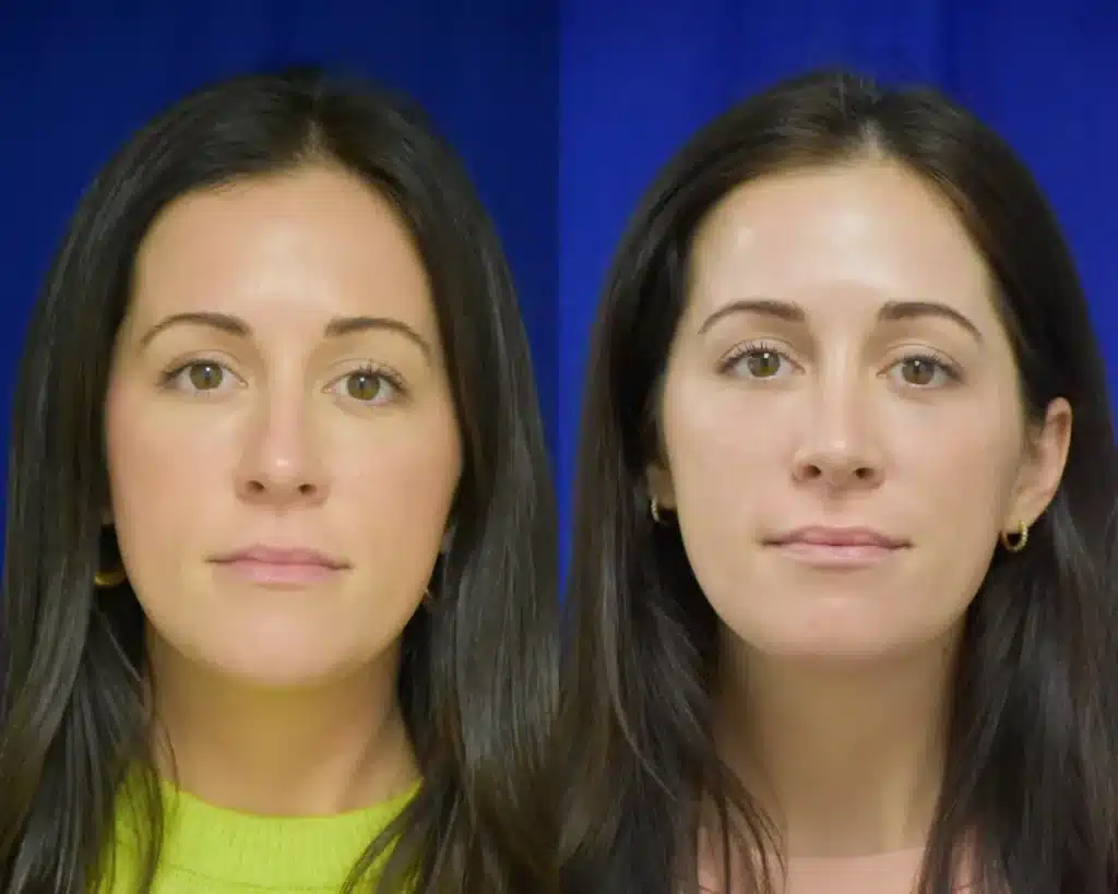 Rhinoplasty before and after photo by Dr. Sean Weiss in Metairie LA