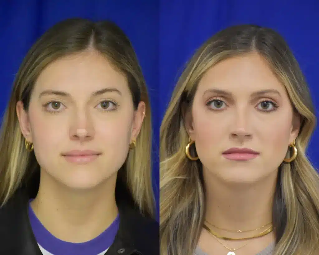 Rhinoplasty before and after photo by Dr. Sean Weiss in Metairie LA
