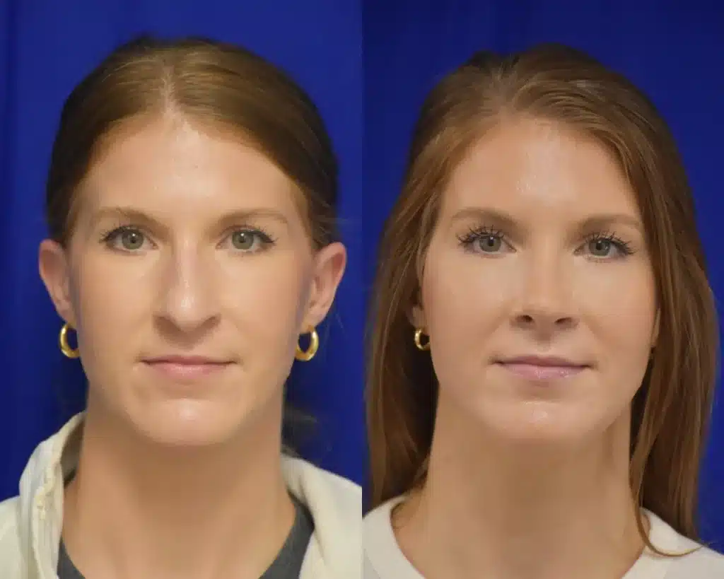 Rhinoplasty before and after photo by Dr. Sean Weiss in Metairie LA
