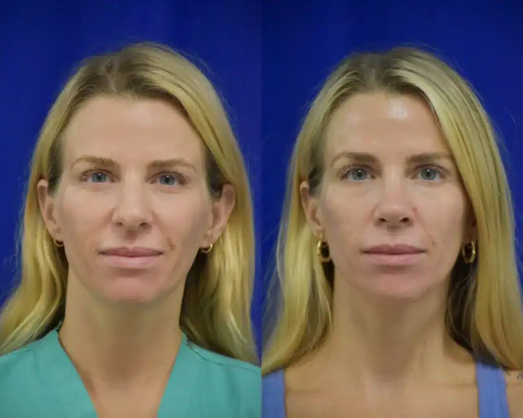 Rhinoplasty before and after photo by Dr. Sean Weiss in Metairie LA
