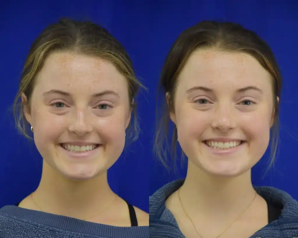 Rhinoplasty before and after photo by Dr. Sean Weiss in Metairie LA