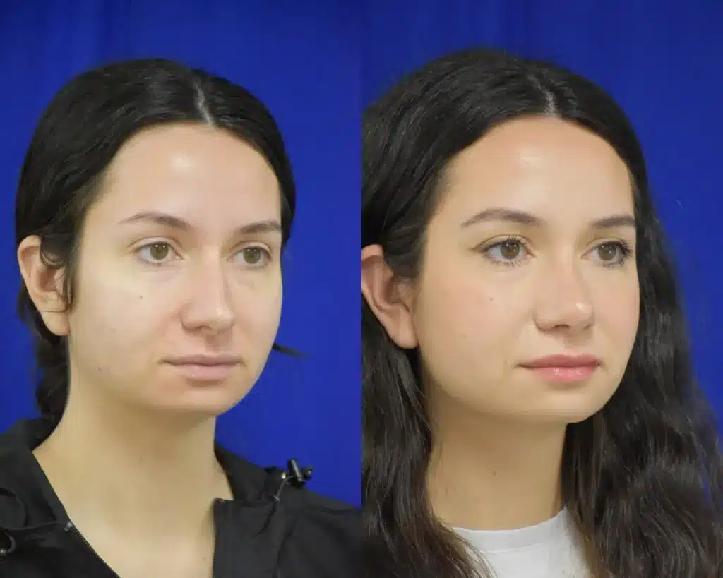 Rhinoplasty before and after photo by Dr. Sean Weiss in Metairie LA