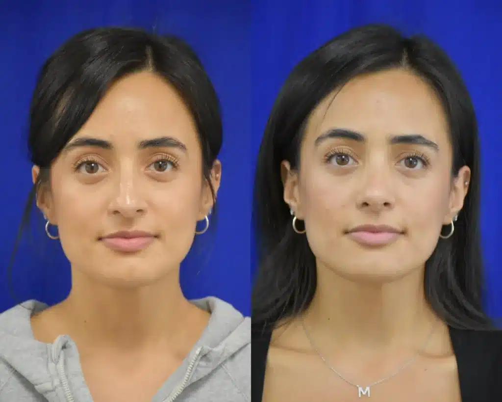 Rhinoplasty before and after photo by Dr. Sean Weiss in Metairie LA