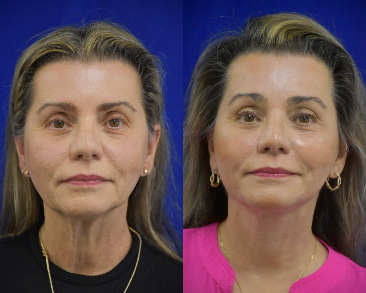 Facelift; Brow Lift, Lower Bleph before and after photo by Dr. Sean Weiss in Metairie LA