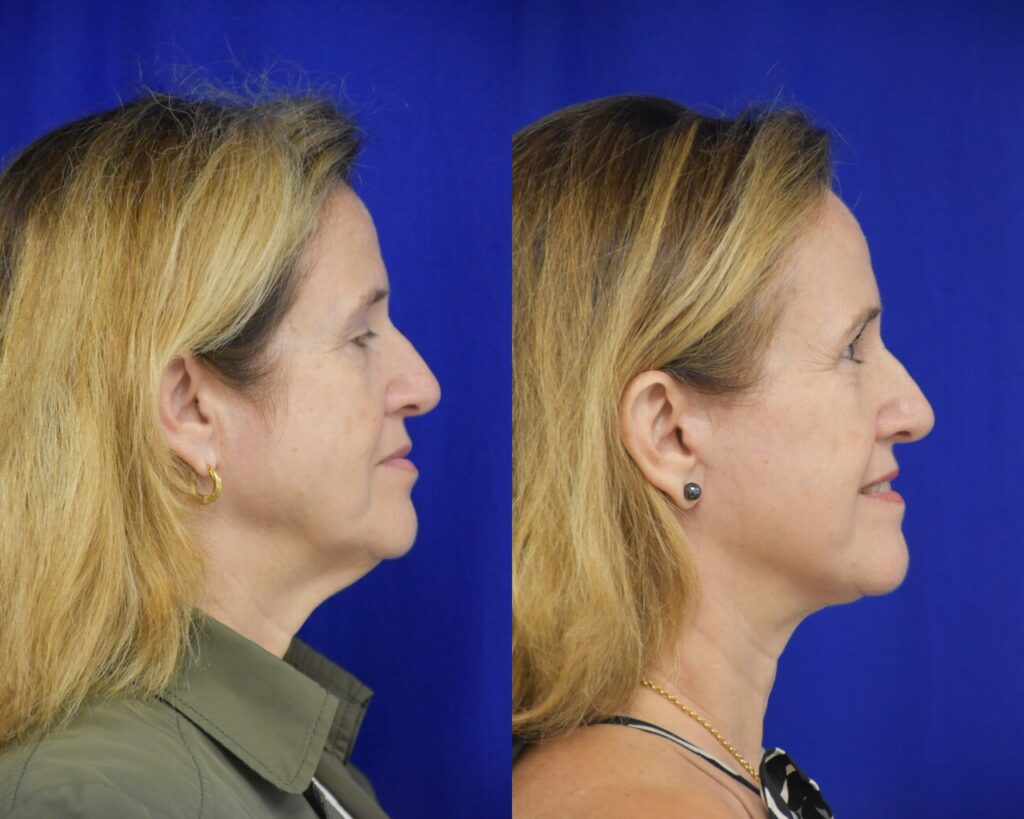 Facelift; Brow Lift before and after photo by Dr. Sean Weiss in Metairie LA