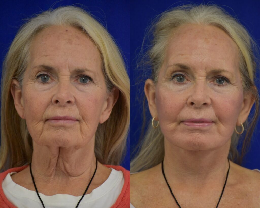 Facelift before and after photo by Dr. Sean Weiss in Metairie LA