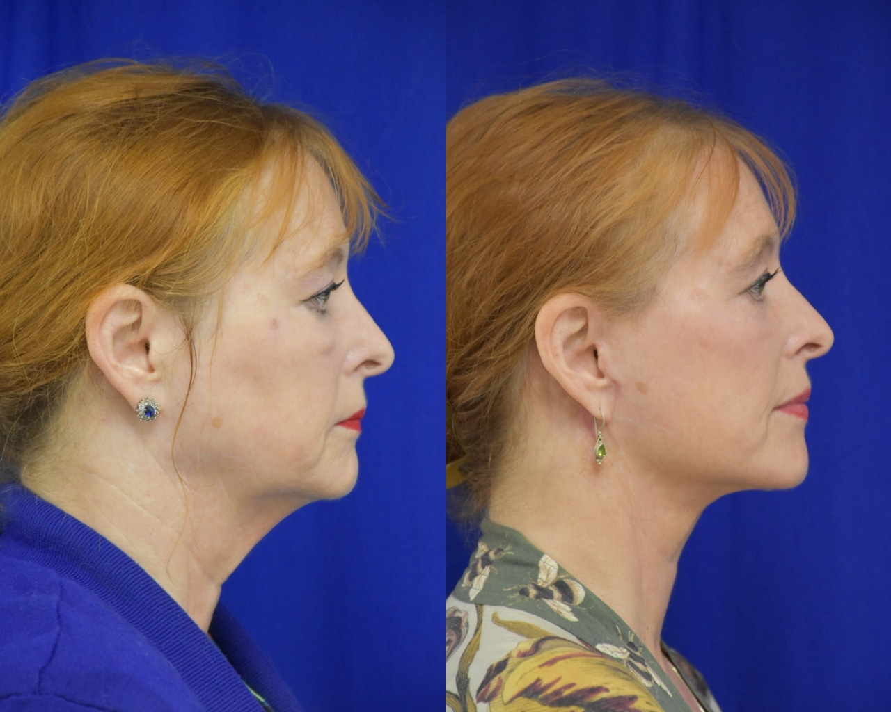 Facelift before and after photo by Dr. Sean Weiss in Metairie LA