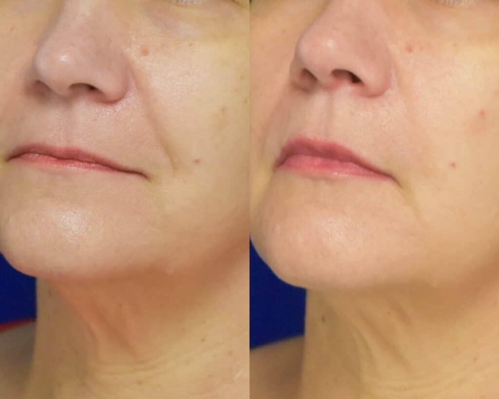 Lip Filler before and after photo by Dr. Sean Weiss in Metairie LA
