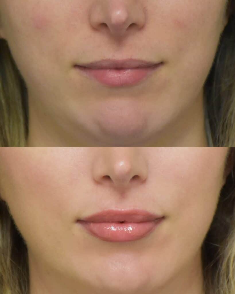 Lip Filler before and after photo by Dr. Sean Weiss in Metairie LA