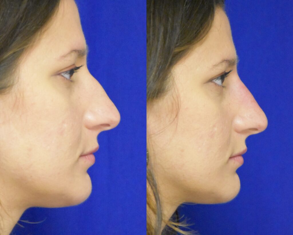 Liquid Rhinoplasty before and after photo by Dr. Sean Weiss in Metairie LA