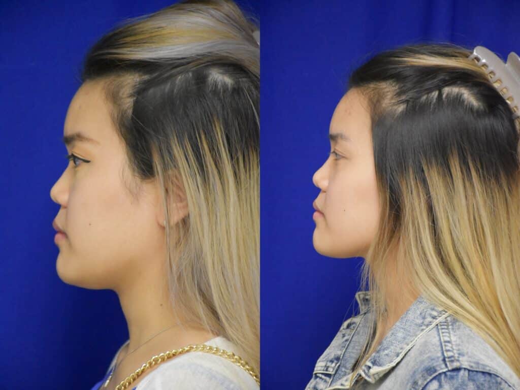Liquid Rhinoplasty before and after photo by Dr. Sean Weiss in Metairie LA