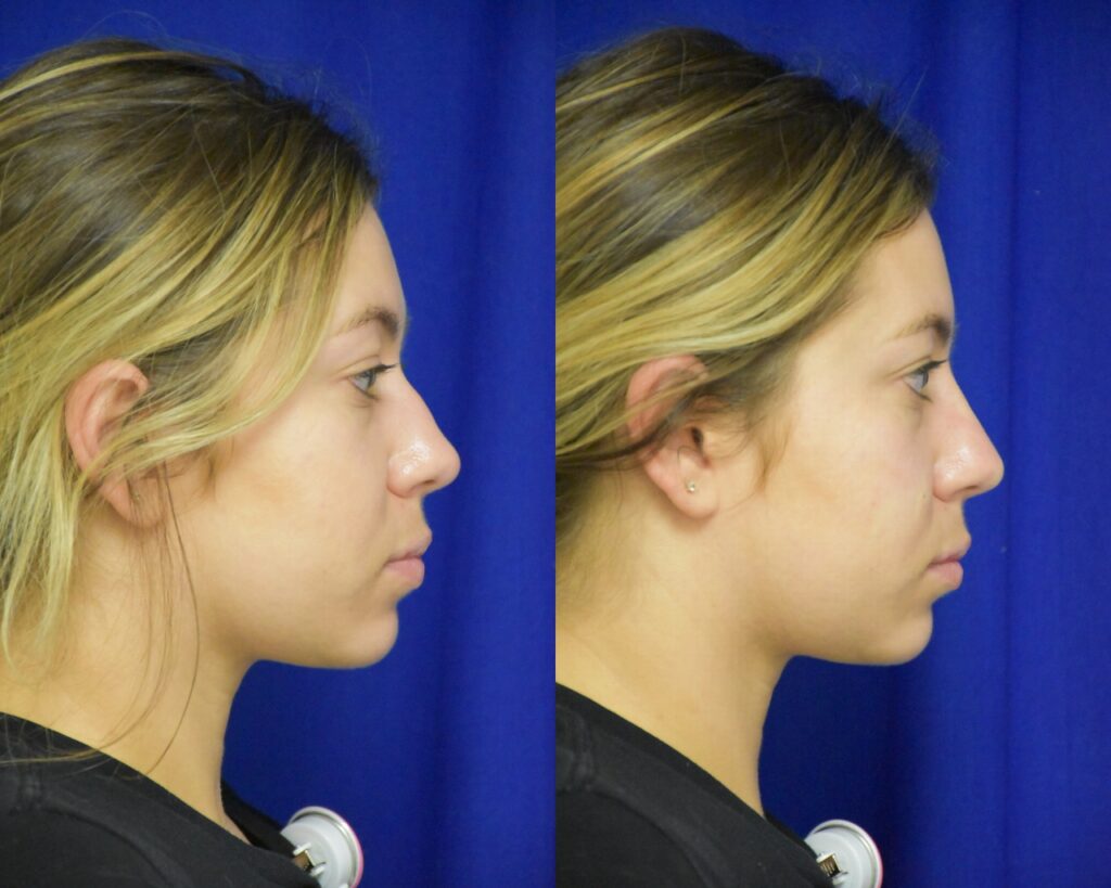 Liquid Rhinoplasty before and after photo by Dr. Sean Weiss in Metairie LA